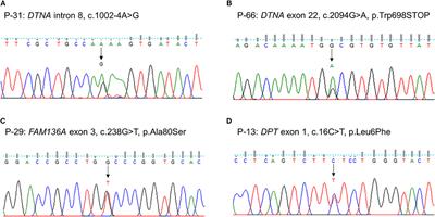 Rare Variants of Putative Candidate Genes Associated With Sporadic Meniere's Disease in East Asian Population